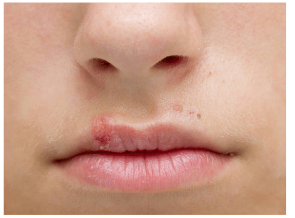How to Get Rid of Cold Sores: And Why It Happens